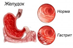 Хронический гастрит – причины, симптомы, лечение и профилактика